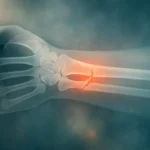Dreaming about a Fracture